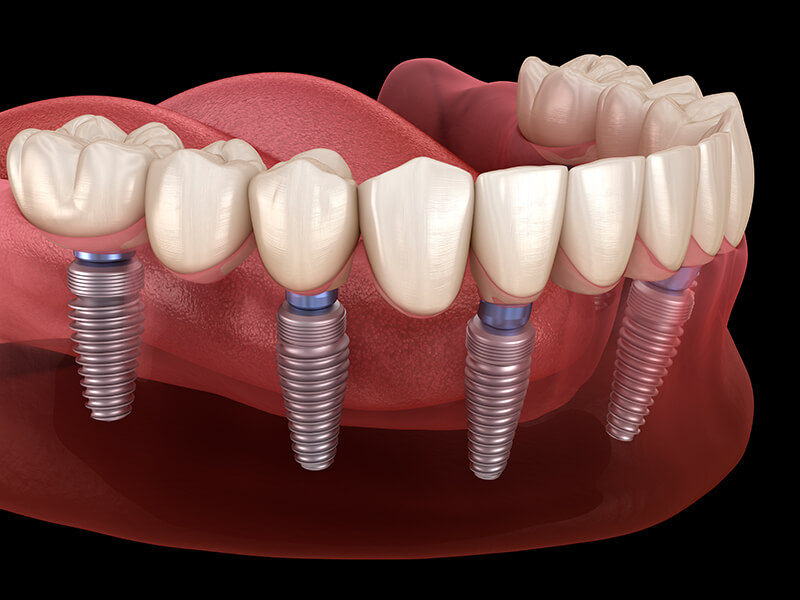 implante dentário