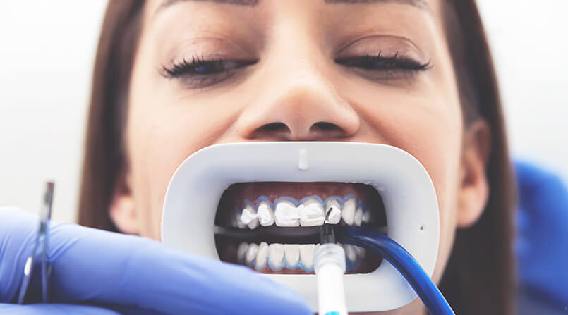 5 fatos sobre o clareamento dental que precisam ser desmistificados