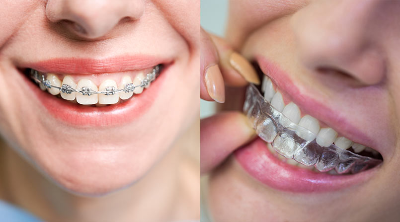 Aparelhos invisíveis x aparelho tradicional: qual é a melhor opção para o seu sorriso?