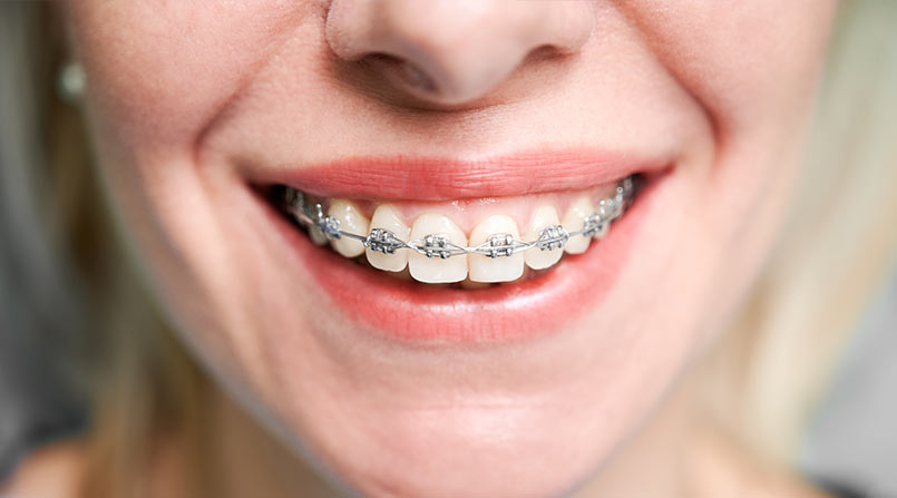 ortodontia na vida adulta